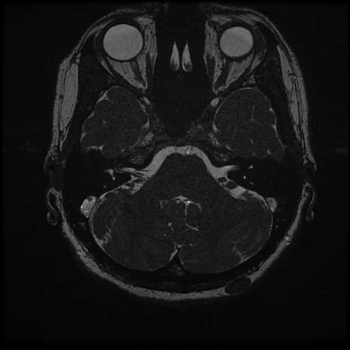 Anterior inferior cerebellar artery vascular loop - type II (Radiopaedia 70991-81209 Axial 3D FIESTA 36).jpg