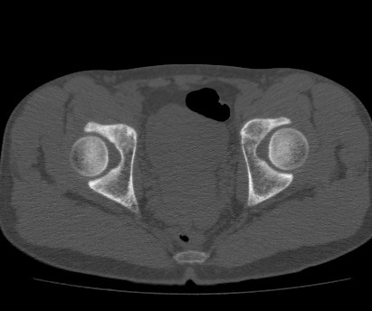 Anterior inferior iliac spine avulsion fracture (Radiopaedia 81312-94999 Axial bone window 52).jpg