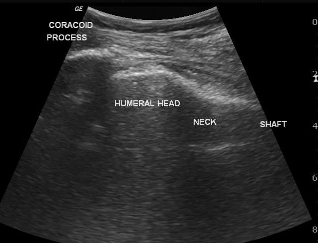 File:Anterior shoulder dislocation - ultrasound (Radiopaedia 23060-23090 Longitudinal 1).jpg