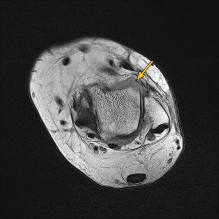 File:Anterior talofibular ligament injury - rupture with soft-tissue impingement (Radiopaedia 38765-66337 Annotated 4).jpg