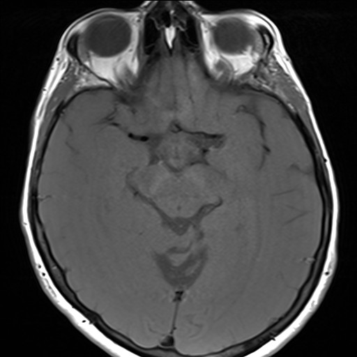 File:Anterior temporal encephalocele (Radiopaedia 82624-96808 Axial T1 16).jpg