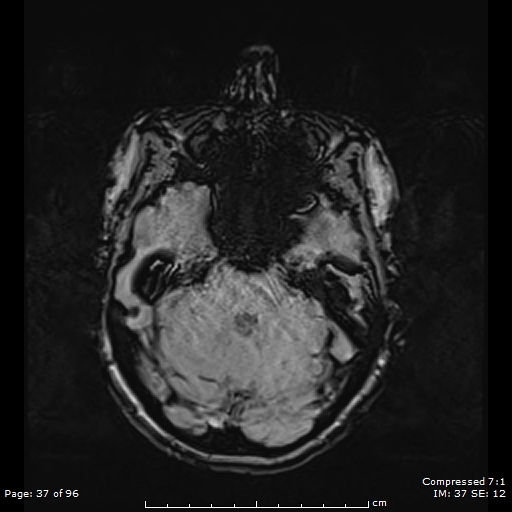 Anterior temporal lobe perivascular space (Radiopaedia 88283-104914 Axial SWI 6).jpg