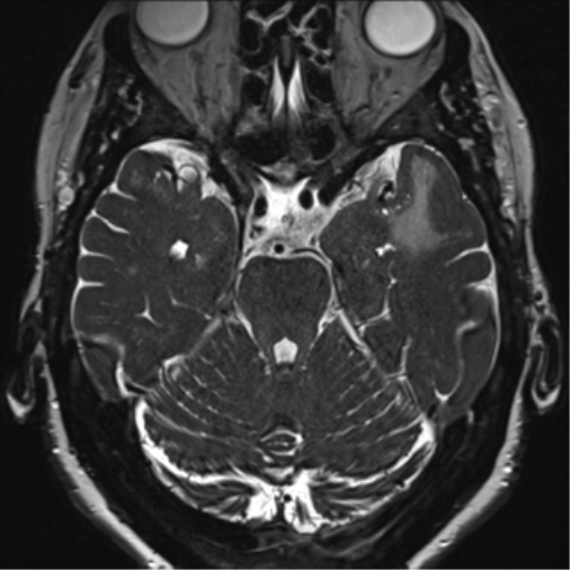 Anterior temporal pole cysts (Radiopaedia 46629-51102 Axial 35).png