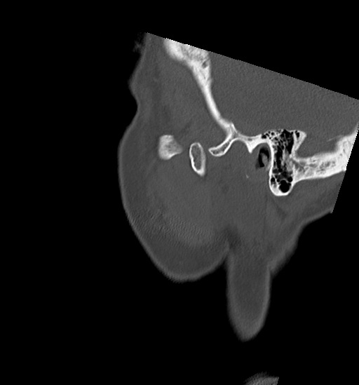 File:Anterior temporomandibular joint dislocation (Radiopaedia 59430-66784 B 59).jpg