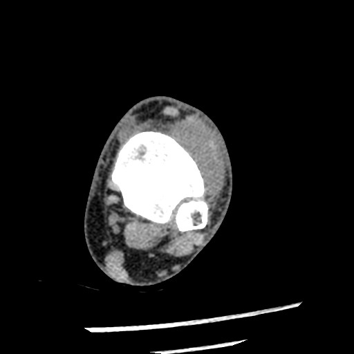 Anterior tibial artery false aneurysm (Radiopaedia 88984-105809 A 97).jpg
