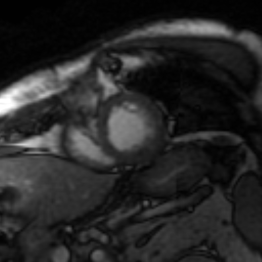 File:Anteroseptal hypokinesia after myocardial infarction (Radiopaedia 15978-15633 Short axis SSFE 5).jpg