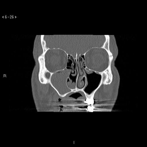 File:Antrochoanal Polyp (Radiopaedia 70510-80631 Coronal bone window 15).jpg