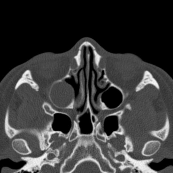Antrochoanal polyp (Radiopaedia 33984-35202 Axial bone window 38).jpg