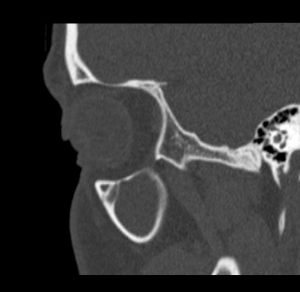 Antrochoanal polyp (Radiopaedia 33984-35202 Sagittal bone window 11).jpg