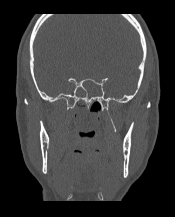 Antrochoanal polyp (Radiopaedia 79011-92169 Coronal bone window 21).jpg