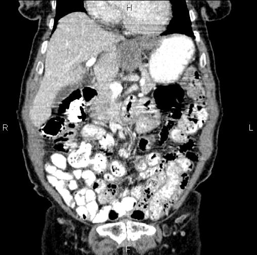 Aortic aneurysm and Lemmel syndrome (Radiopaedia 86499-102554 C 18).jpg