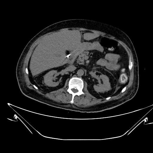 Aortic arch aneurysm (Radiopaedia 84109-99365 Axial non-contrast 318).jpg