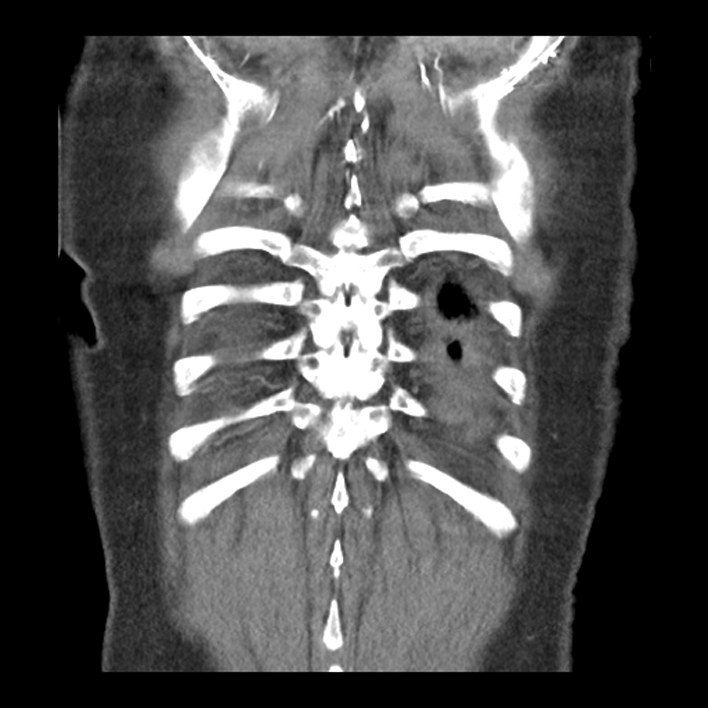 Aortic arch graft infection (FDG PET-CT) (Radiopaedia 71975-82437 Coronal 54).jpg