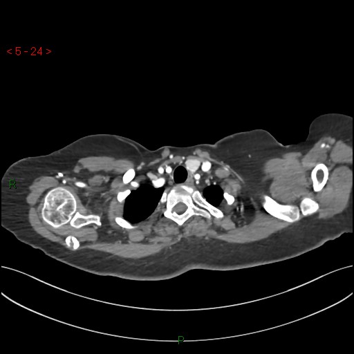 File:Aortic arch origin of left vertebral artery (Radiopaedia 51520-57286 A 23).jpg