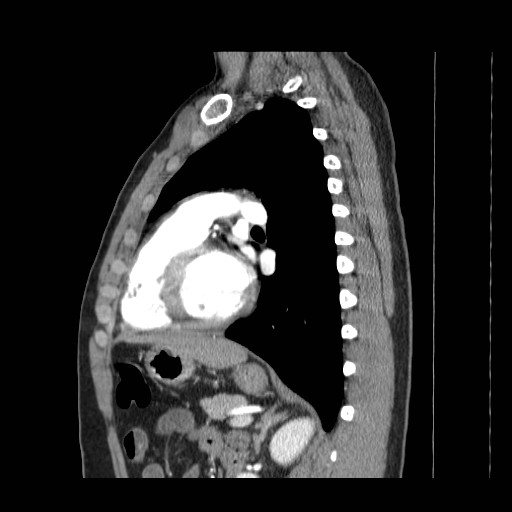 File:Aortic arch stent (Radiopaedia 30030-30595 E 19).jpg