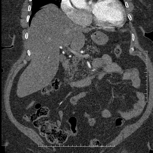 Aortic dissection- Stanford A (Radiopaedia 35729-37268 F 47).jpg