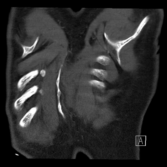 File:Aortic dissection (CTPA) (Radiopaedia 75506-86750 B 71).jpg