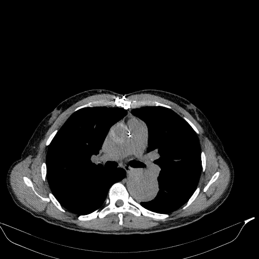 Aortic dissection - Stanford type A (Radiopaedia 83418-98500 Axial non-contrast 19).jpg