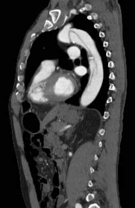 File:Aortic dissection - Stanford type B (Radiopaedia 73648-84437 C 60).jpg