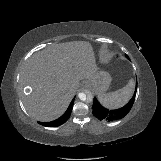 Aortic dissection - Stanford type B (Radiopaedia 88281-104910 A 83).jpg