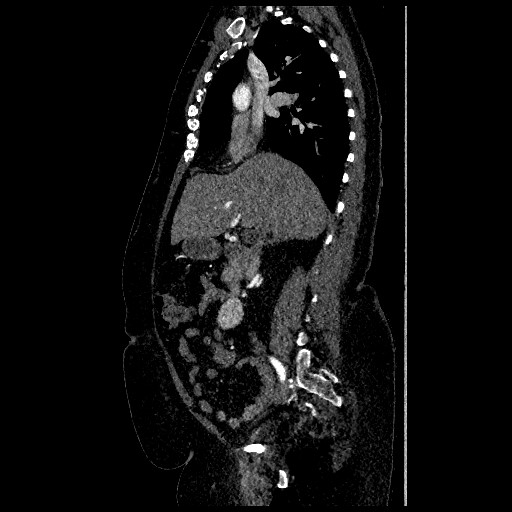 File:Aortic dissection - Stanford type B (Radiopaedia 88281-104910 C 28).jpg