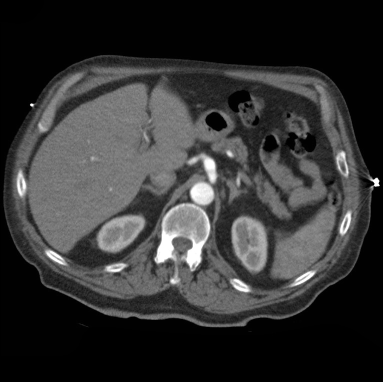Aortic dissection with rupture into pericardium (Radiopaedia 12384-12647 A 55).jpg