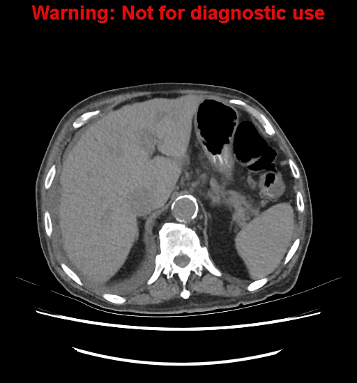 Aortic graft infection (Radiopaedia 44979-48907 Axial non-contrast 28).jpg