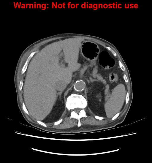Aortic graft infection (Radiopaedia 44979-48907 Axial non-contrast 32).jpg