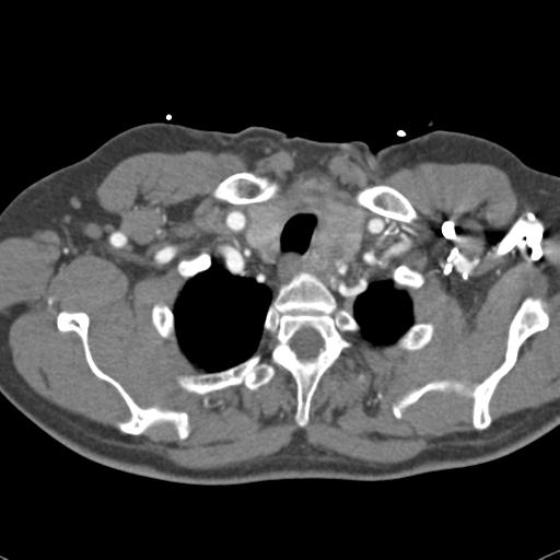 Aortic intramural hematoma (Radiopaedia 31139-31838 B 10).jpg