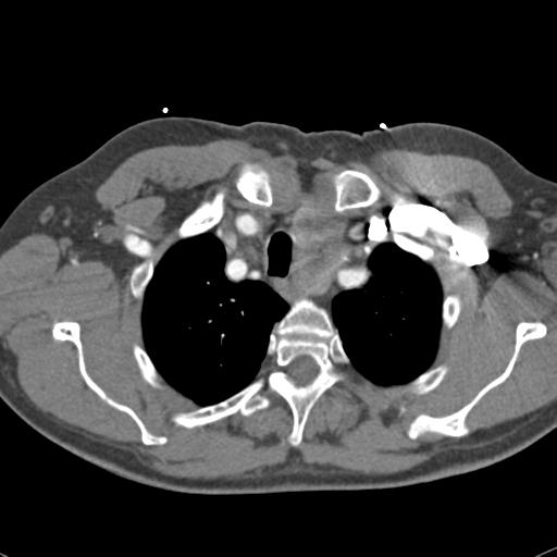 Aortic intramural hematoma (Radiopaedia 31139-31838 B 15).jpg