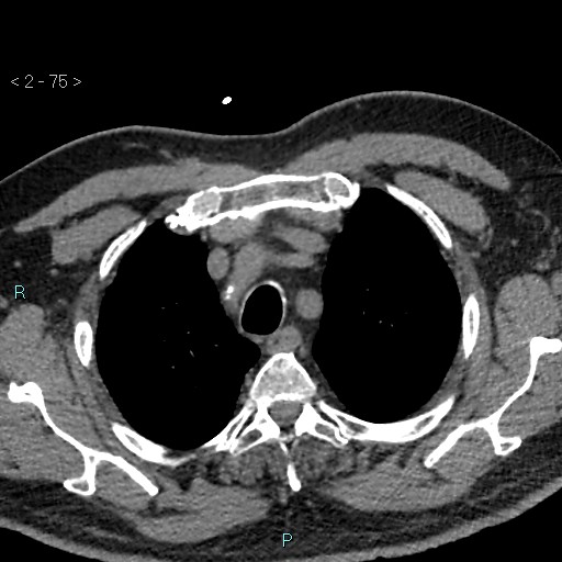 Aortic intramural hematoma (Radiopaedia 48463-53380 Axial non-contrast 33).jpg