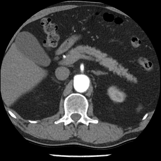 Aortic intramural hematoma (type B) (Radiopaedia 79323-92387 B 61).jpg