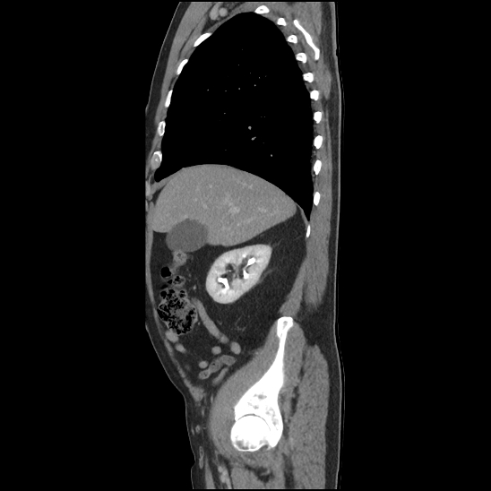 Aortic intramural hematoma (type B) (Radiopaedia 79323-92387 Sagittal C+ delayed 8).jpg