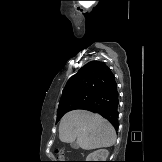 Aortic intramural hematoma with dissection and intramural blood pool (Radiopaedia 77373-89491 D 20).jpg