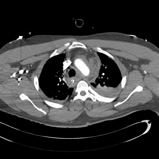 Aortic transection, diaphragmatic rupture and hemoperitoneum in a complex multitrauma patient (Radiopaedia 31701-32622 A 27).jpg