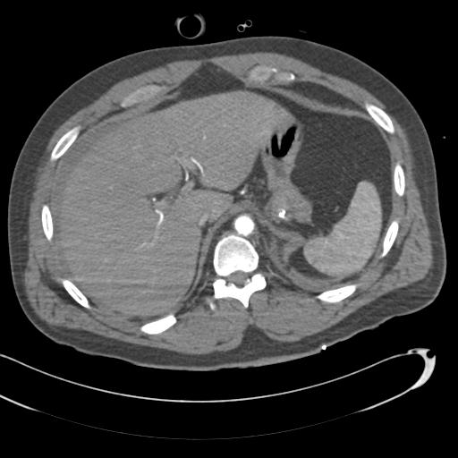 Aortic transection, diaphragmatic rupture and hemoperitoneum in a complex multitrauma patient (Radiopaedia 31701-32622 A 81).jpg