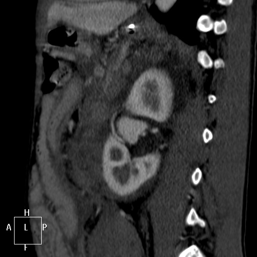 Aorto-left renal vein fistula (Radiopaedia 45534-49628 C 47).jpg