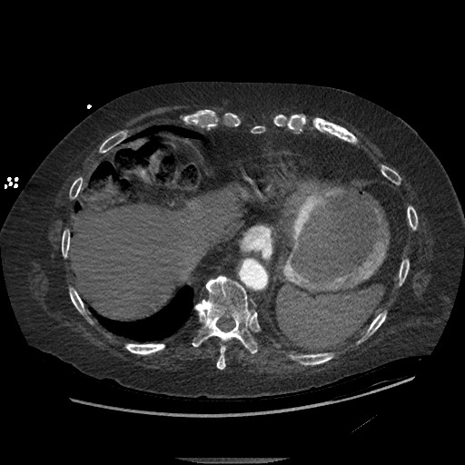 File:Aortoesophageal fistula with endovascular repair (Radiopaedia 73781-84592 Axial C+ CTPA 141).jpg