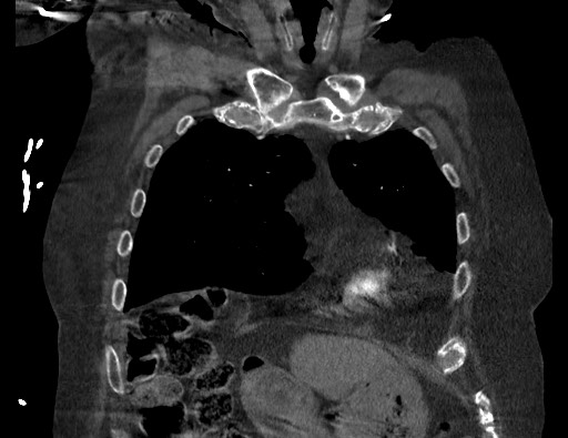 Aortoesophageal fistula with endovascular repair (Radiopaedia 73781-84592 Coronal C+ CTPA 22).jpg