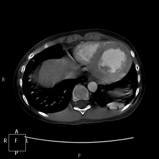 File:Aortopulmonary septal defect (Radiopaedia 41990-45013 Axial C+ CTPA 11).jpg