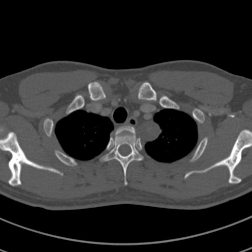 Apical lung mass mimic - neurogenic tumor (Radiopaedia 59918-67521 Axial bone window 12).jpg