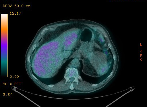 File:Appendiceal adenocarcinoma complicated by retroperitoneal abscess (Radiopaedia 58007-65041 Axial PET-CT 103).jpg