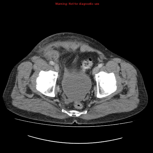 File:Appendicitis mass in inguinal hernia (Radiopaedia 26858-27029 A 23).jpg