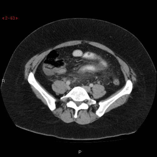 Appendicitis with microperforation- promontoric type (Radiopaedia 27268-27442 C 51).jpg