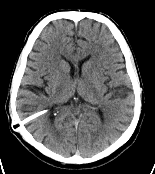 File:Aqueduct stenosis with corpus callosum hypoattenuation post shunting (Radiopaedia 37212-38971 Axial non-contrast 15).png