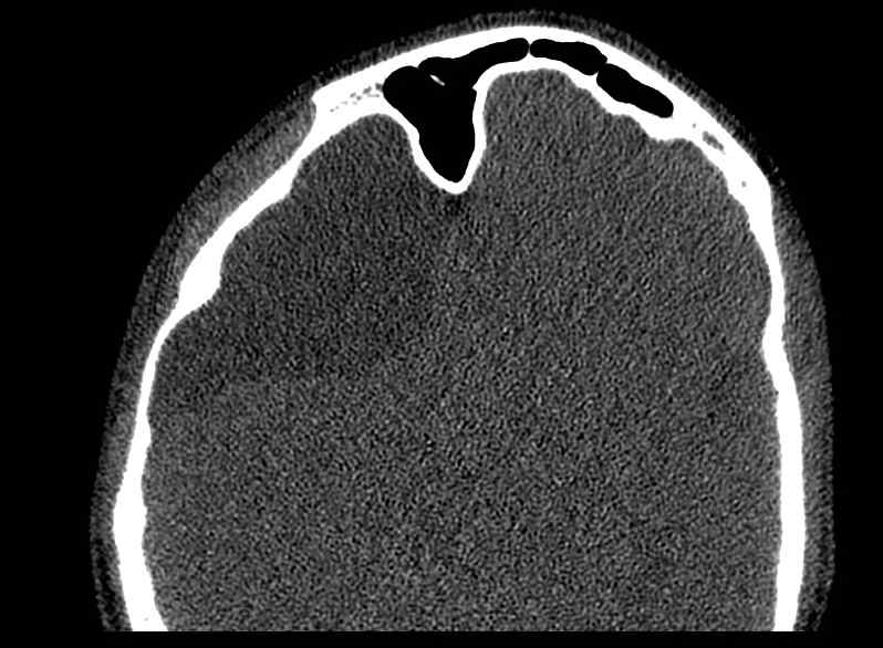 File:Arachnoid cyst- extremely large (Radiopaedia 68741-78450 Axial bone window 46).jpg