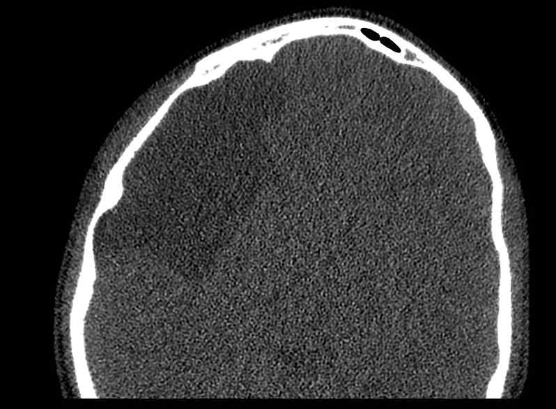 Arachnoid cyst- extremely large (Radiopaedia 68741-78450 Axial bone window 55).jpg