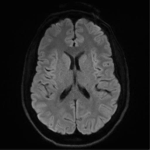 Arachnoid cyst - cerebellopontine angle (Radiopaedia 59689-67083 Axial DWI 57).png