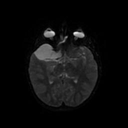 Arachnoid cyst - middle cranial fossa (Radiopaedia 67671-77088 Axial DWI 39).jpg