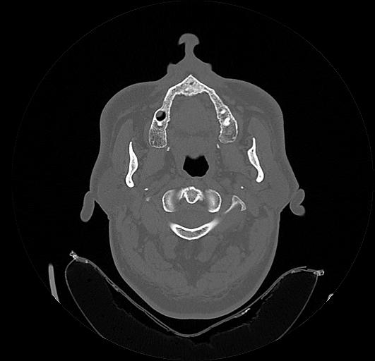 Arcuate foramen (Radiopaedia 89833-106944 Axial bone window 36).jpg